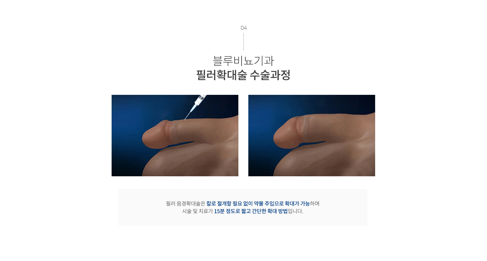 남성수술 이미지12