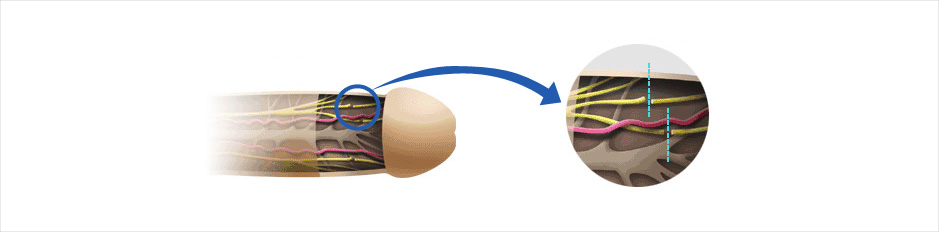 음경배부신경차단술